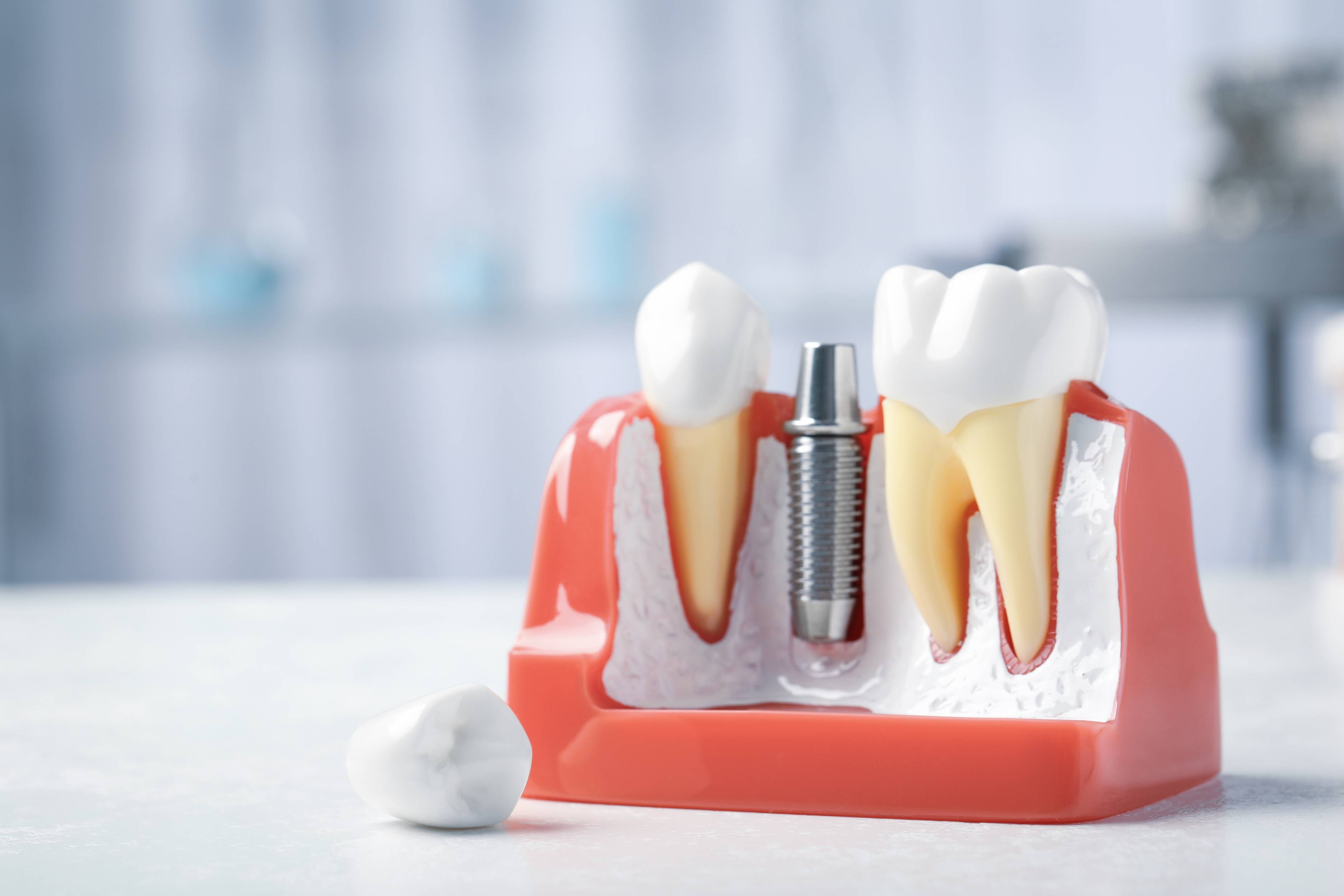 Service Implant Service Implant